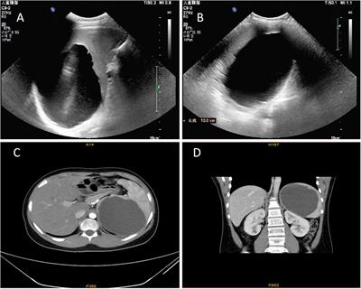 Transumbilical single-site laparoscopic treatment of primary splenic cyst in child: a rare case report and review of literature